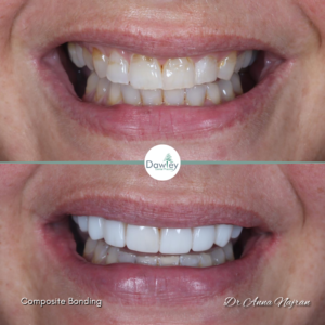 Composite bonding smile makeover by Anna Najran at Dawley Dental Practice Telford