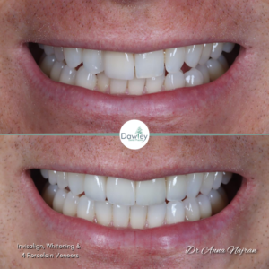 Invisalign whitening and porcelain veneers smile makeover by Anna Najran in Telford