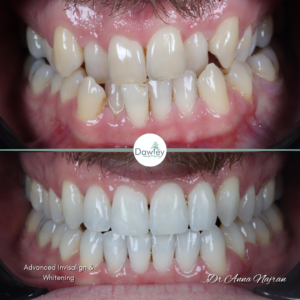 Advanced Invisalign and teeth whitening smile makeover by Anna Najran in Telford